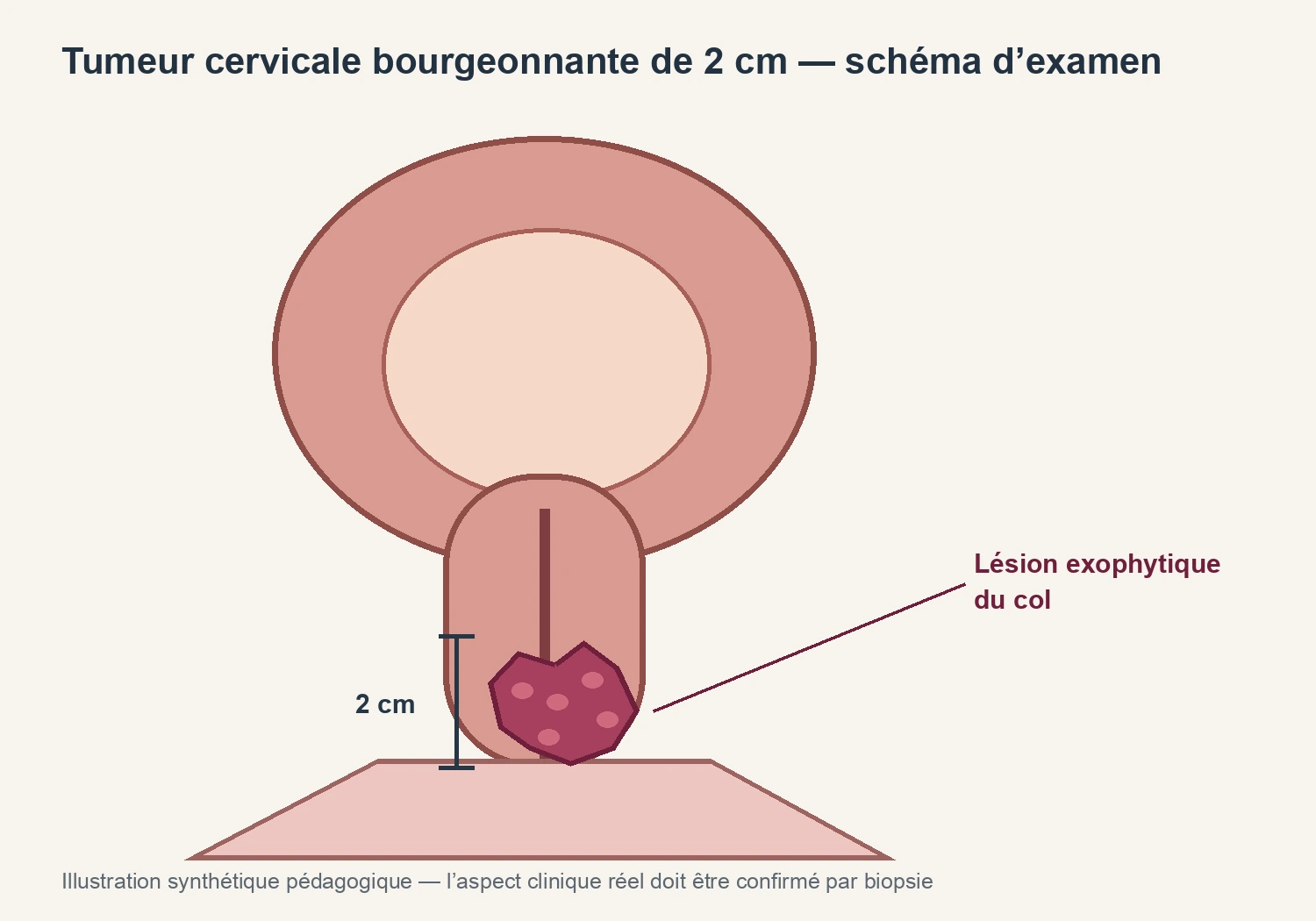 Illustration pédagogique synthétique — Tumeur cervicale bourgeonnante de 2 cm