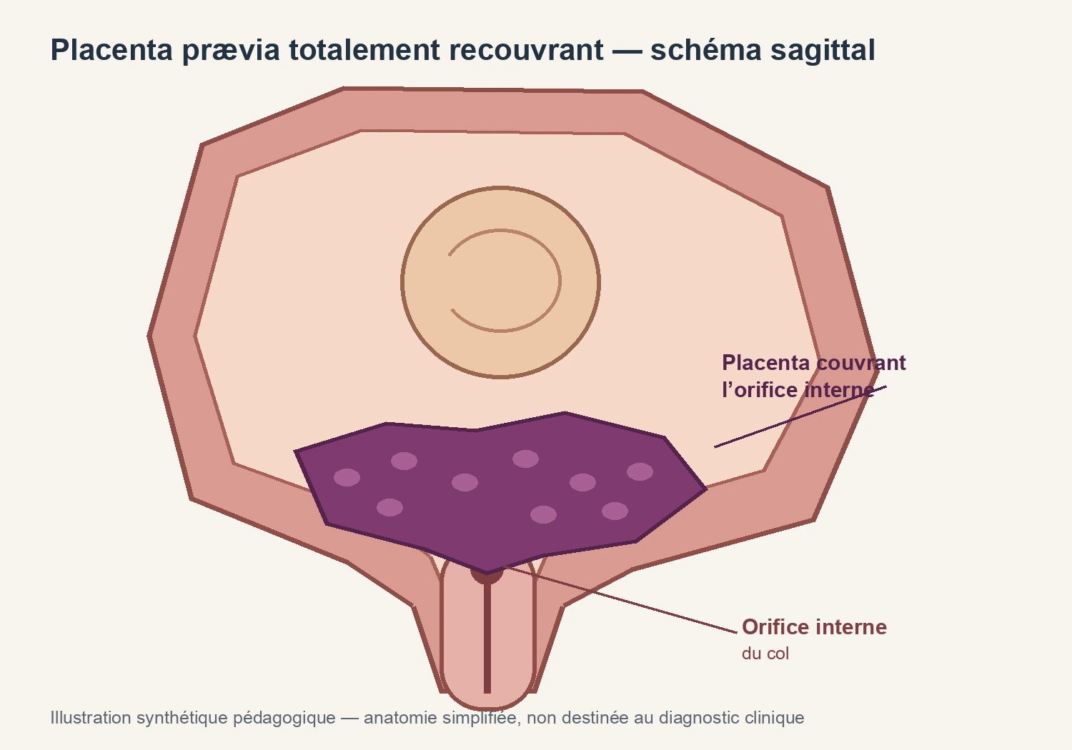 Illustration pédagogique synthétique — Placenta prævia totalement recouvrant