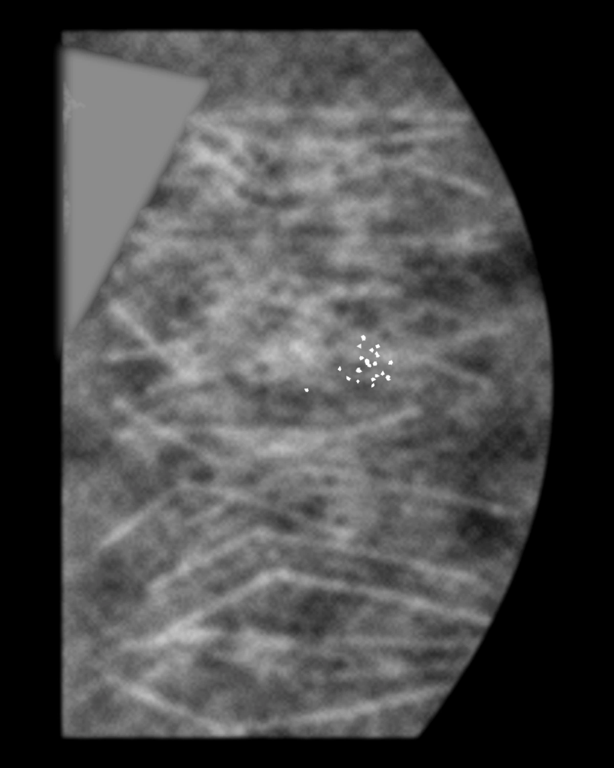 Illustration pédagogique synthétique — Foyer non étendu de microcalcifications suspectes ACR4