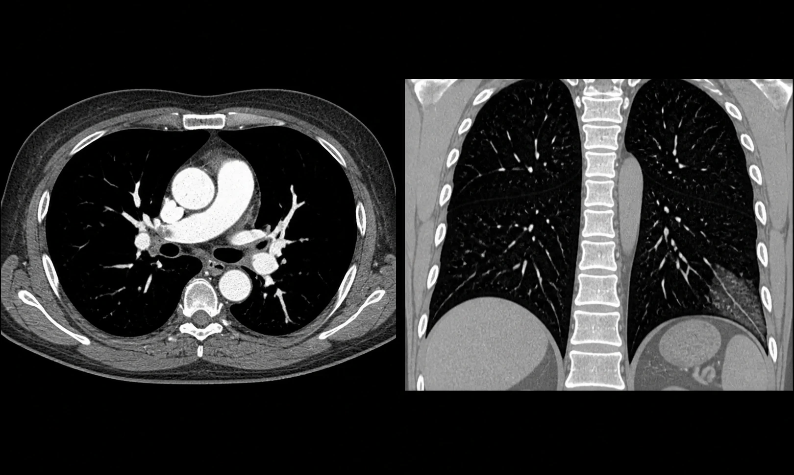 Illustration pédagogique synthétique — Embolie pulmonaire bilatérale avec infarctus pulmonaire périphérique