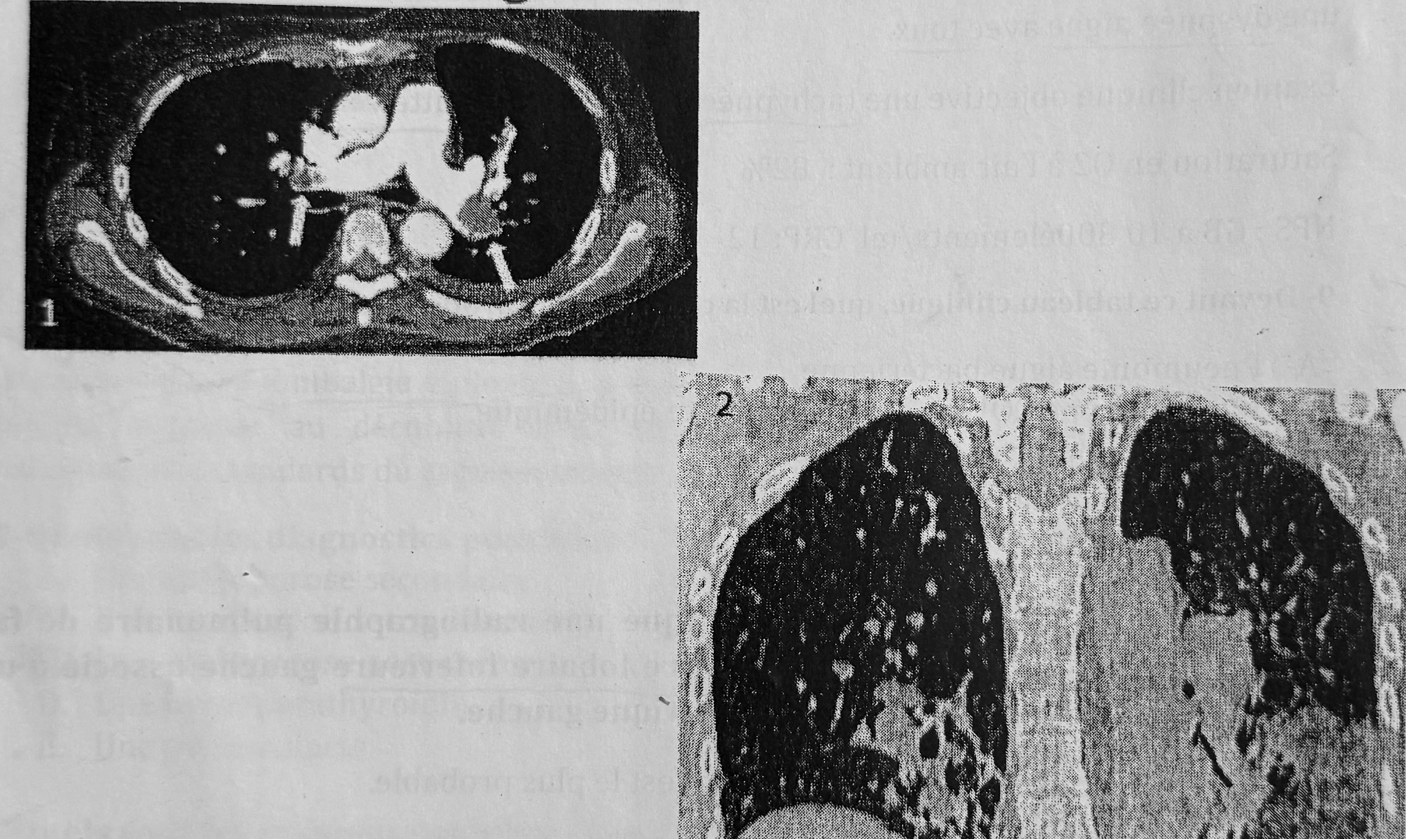 Visuel fidèle à la source — Embolie pulmonaire bilatérale avec infarctus pulmonaire périphérique