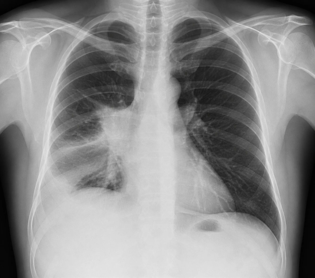 Illustration pédagogique synthétique — Cancer bronchopulmonaire central droit avec remaniements post-obstructifs