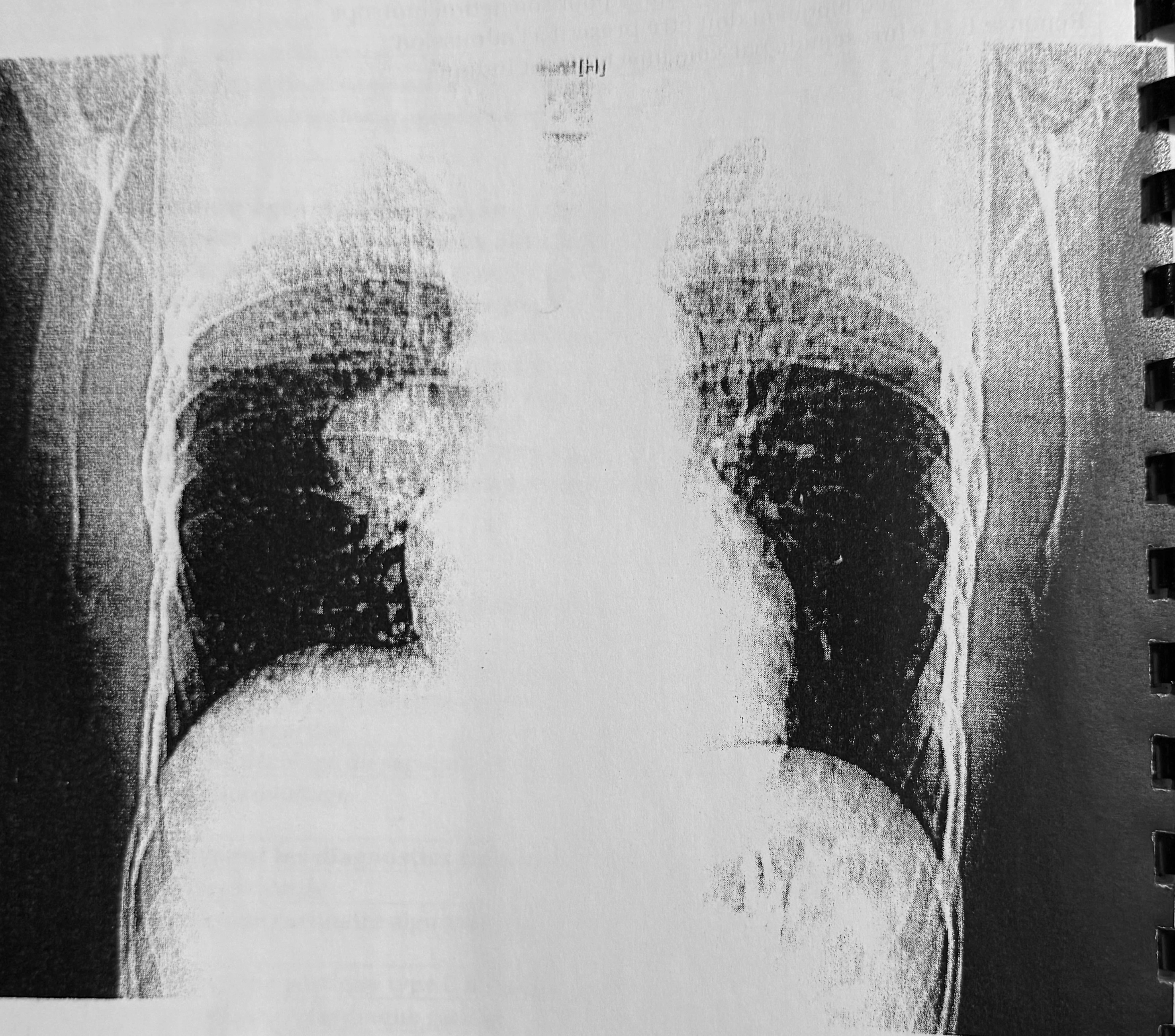 Visuel fidèle à la source — Cancer bronchopulmonaire central droit avec remaniements post-obstructifs