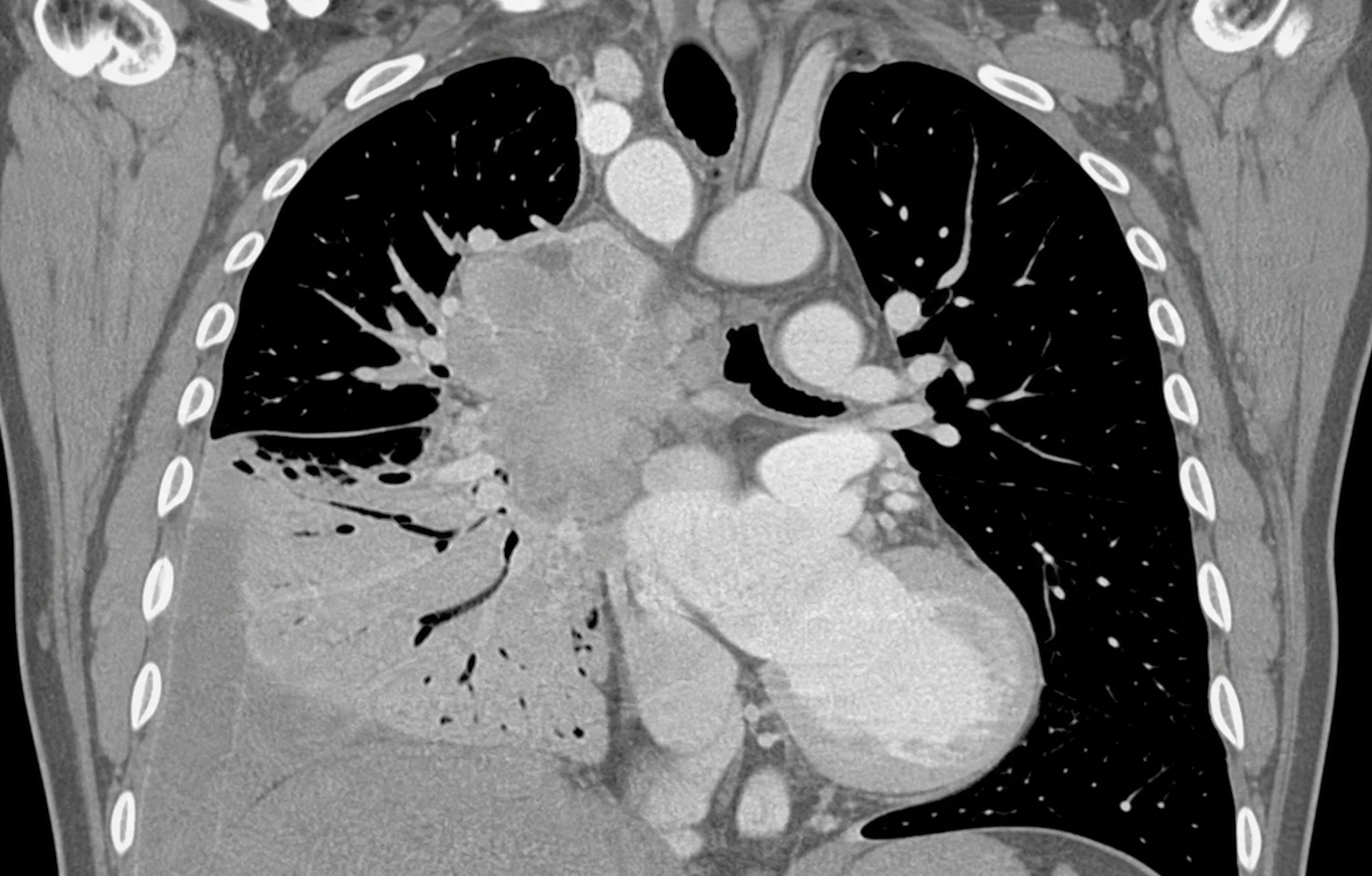 Illustration pédagogique synthétique — Cancer bronchopulmonaire central droit localement invasif