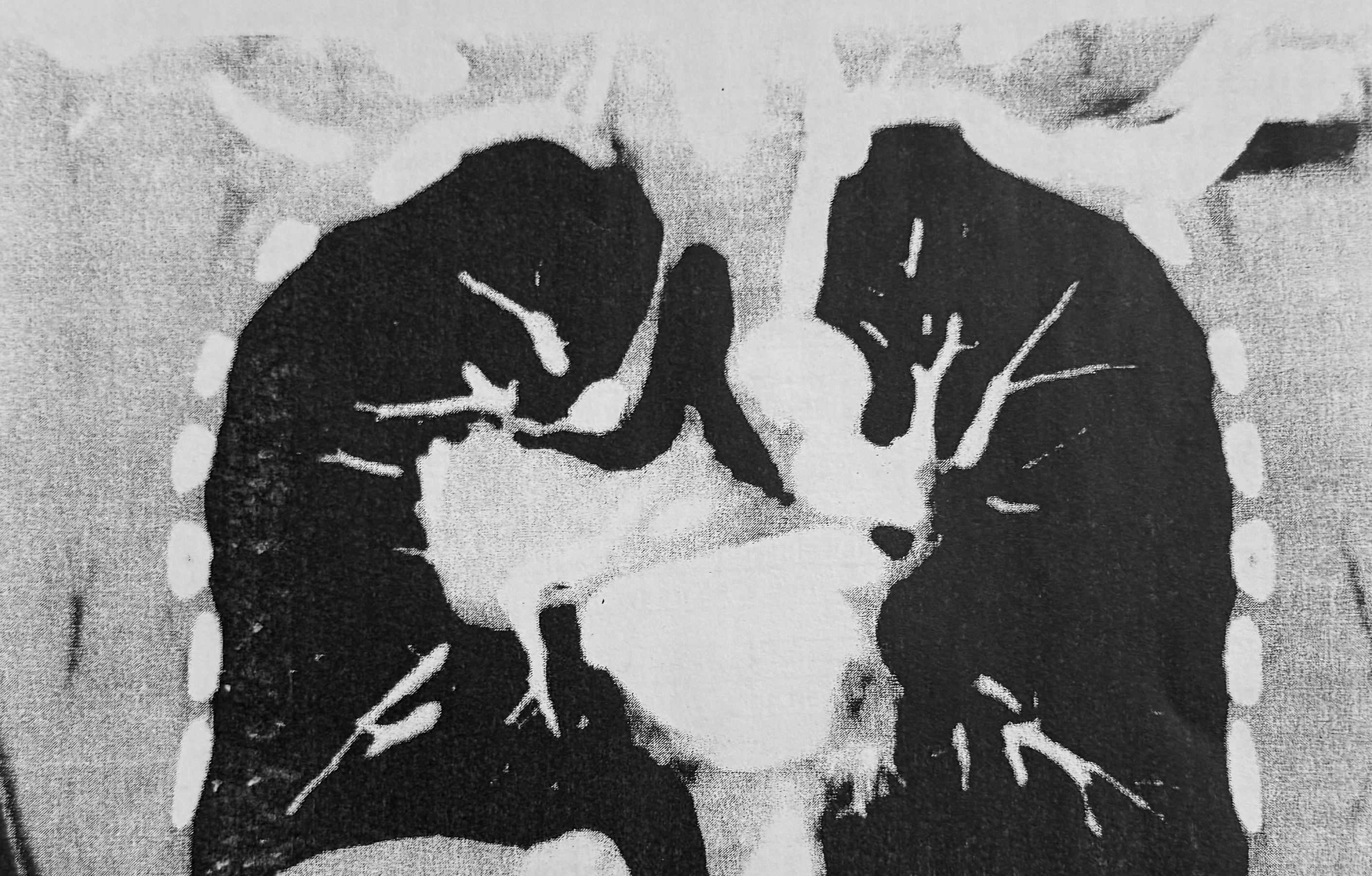 Visuel fidèle à la source — Cancer bronchopulmonaire central droit localement invasif