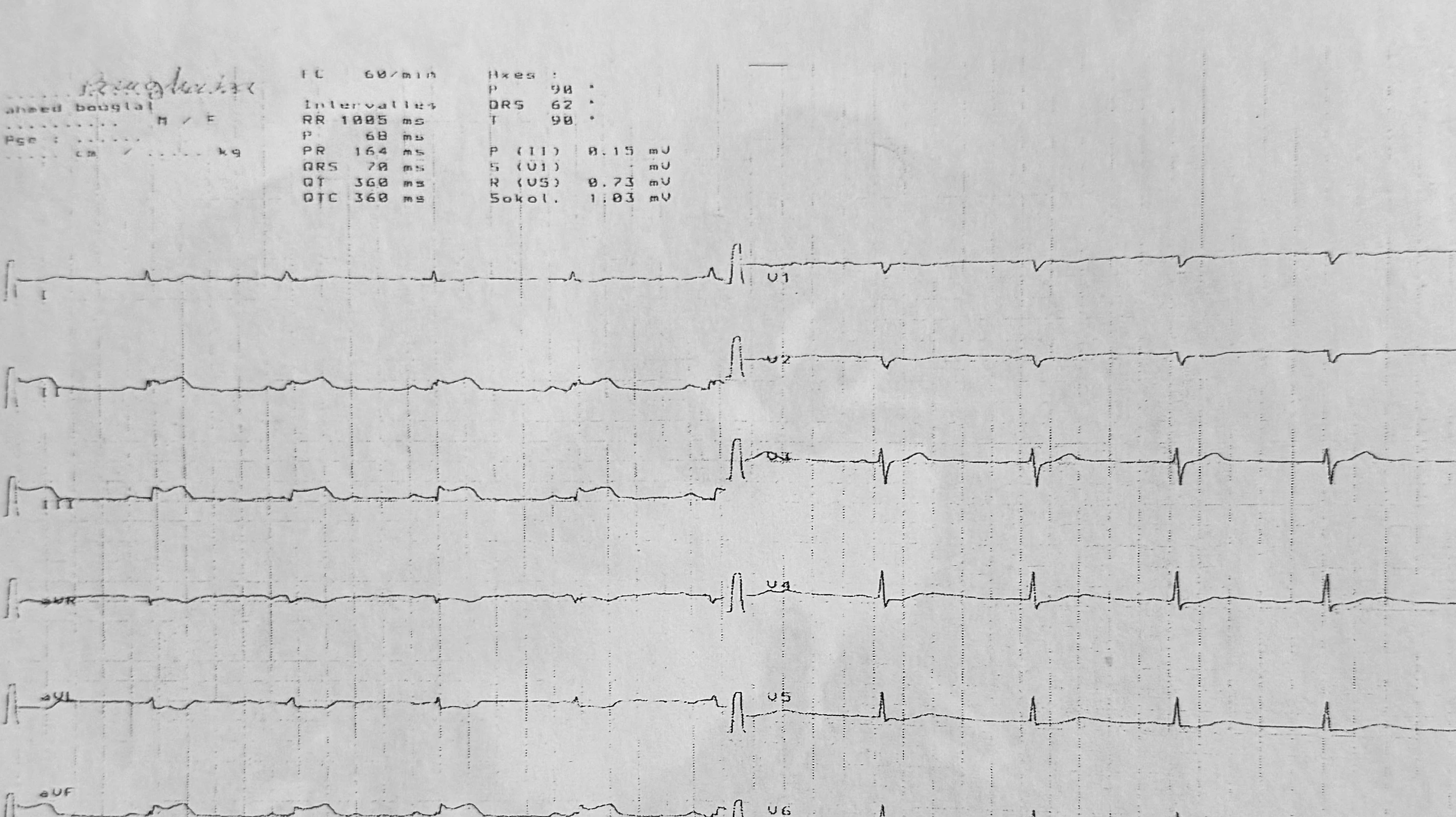 Visuel fidèle à la source — STEMI inférieur compliqué de choc cardiogénique, avec suspicion d’insuffisance mitrale aiguë