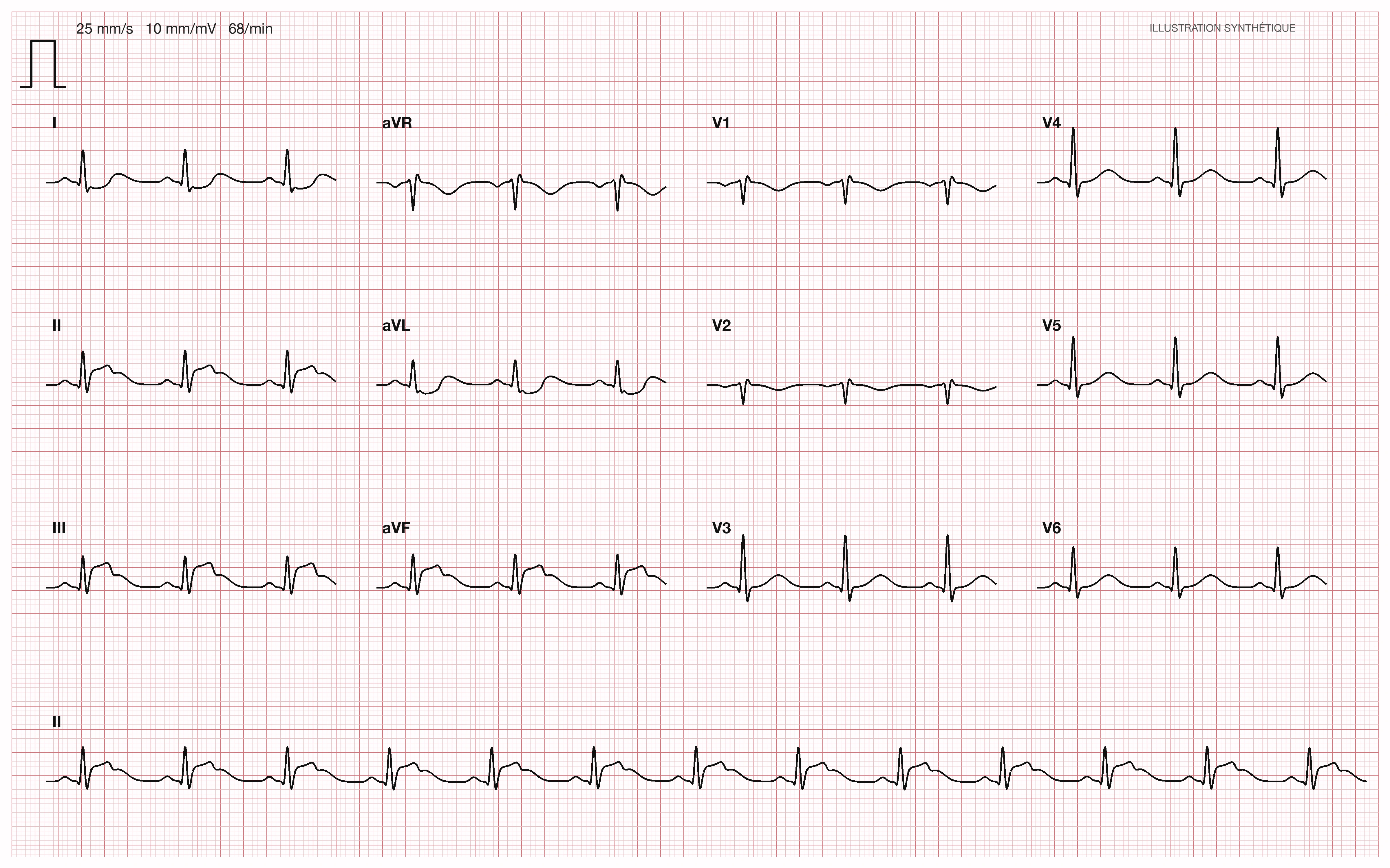 Illustration pédagogique synthétique — STEMI inférieur compliqué de choc cardiogénique, avec suspicion d’insuffisance mitrale aiguë