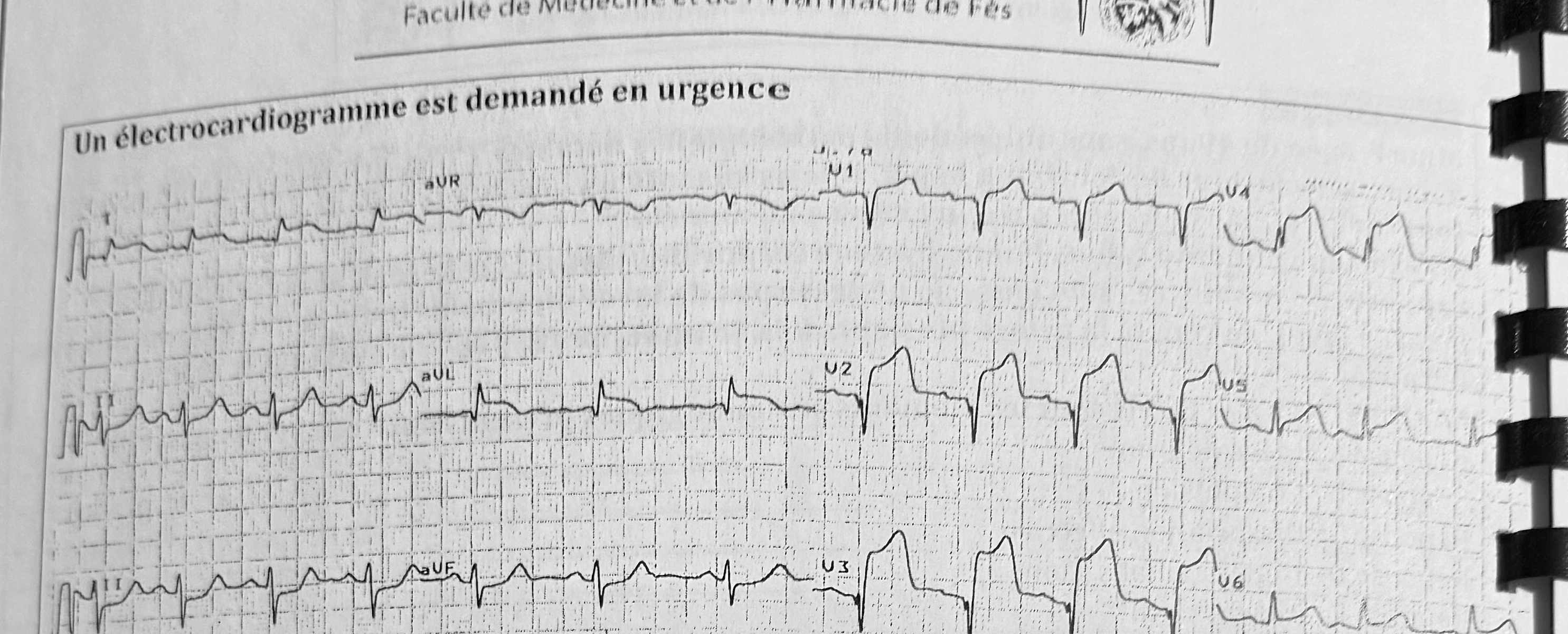 Visuel fidèle à la source — STEMI antérieur étendu